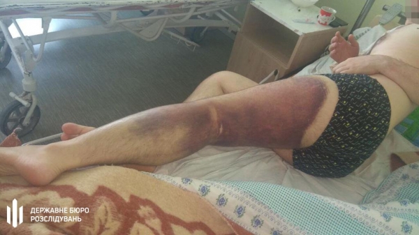 В Николаеве копов обвинили в зверском избиении. Фото 18+
В Николаеве копов обвинили в зверском избиении. Фото 18+