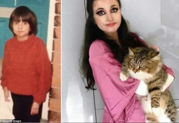С таким диагнозом многие не доживают и до 5 лет, а она отметила 35: девушка имеет кожу бабочки и страдает каждый день С таким диагнозом многие не доживают и до 5 лет, а она отметила 35: девушка имеет кожу бабочки и страдает каждый день