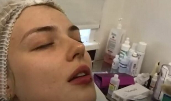 Блогерша увеличила губы филлером и не узнала свой подбородок: "Начинает передвигаться..." Блогерша увеличила губы филлером и не узнала свой подбородок: "Начинает передвигаться..."