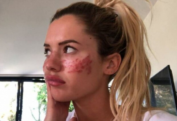 Звезда соцсетей после бьюти-хака из TikTok едва не ослепла и покрылась шрамами: "Умоляю, не пробуйте..." Звезда соцсетей после бьюти-хака из TikTok едва не ослепла и покрылась шрамами: "Умоляю, не пробуйте..."